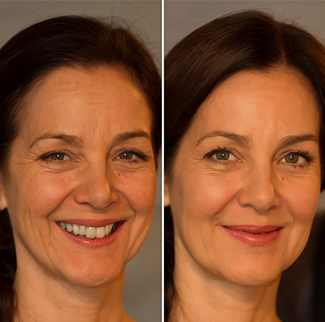 Antes y después del tratamiento de patas de gallo